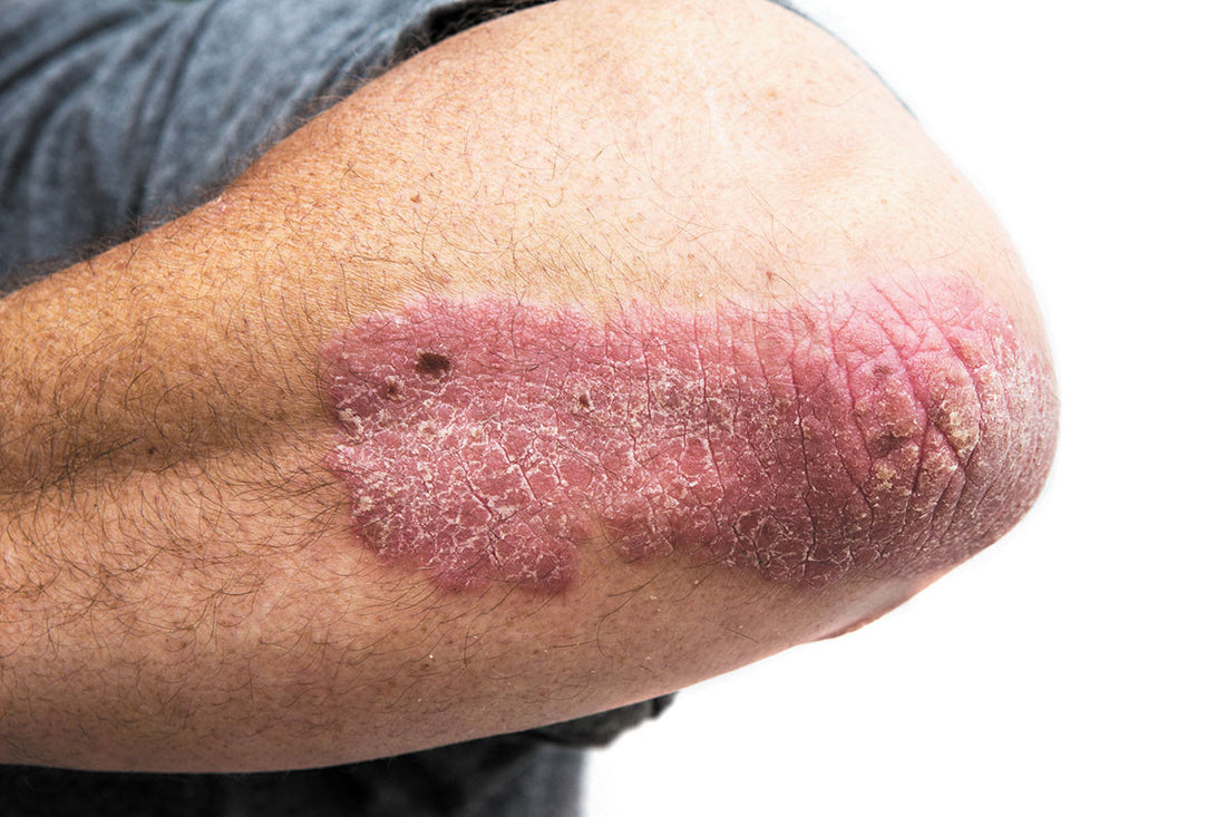 ​Psoriasis Is More Than Skin Deep: Could Molecular Hydrogen Help?